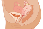 Tilted Uterus: Types, Causes and Treatments